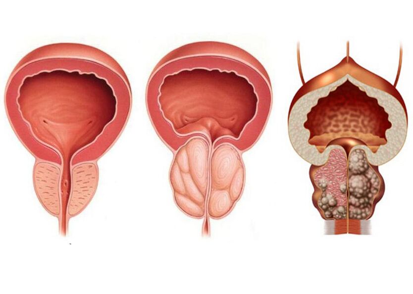 Fasi della prostatite e necessità di trattamento con Prostavit