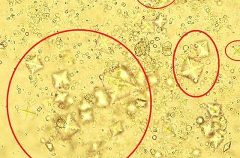 Ecco come appaiono al microscopio i cristalli di sale contenuti nelle urine nella prostatite calcolosa